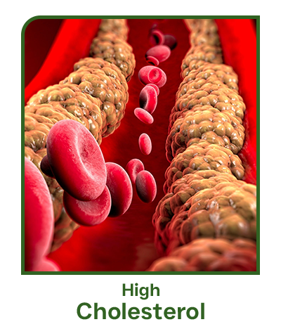 high cholesterol
